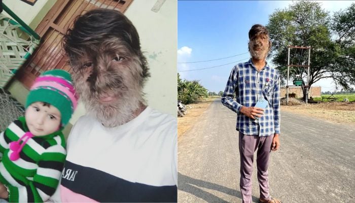 Bhediya Review: All You Need To Know About The Werewolf Syndrome 88 Werewolf syndrome': Meet India teenager with hair all over his body