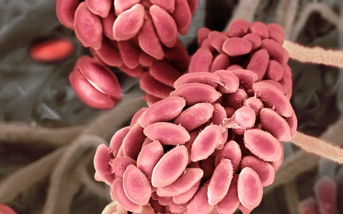 A Kolkata Man First To Suffer From A Disease Coming From Plants 87 Indian man is first human to be infected by a plant fungus