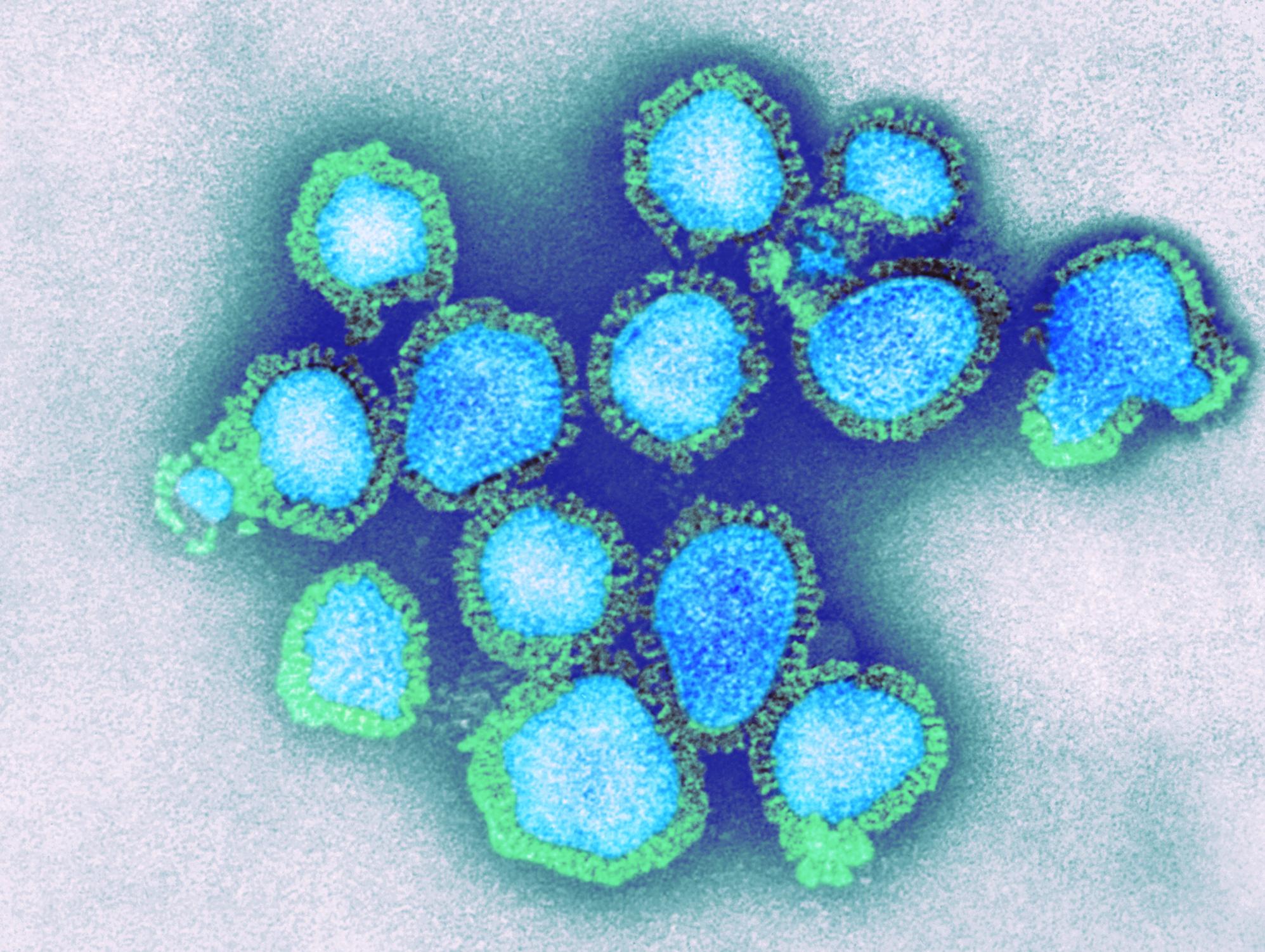 First Death Due To H3N2 Reported In Karnataka - All You Need To Know 87 H3N2 virus hits India: All you need to know about this viral outbreak - India Today