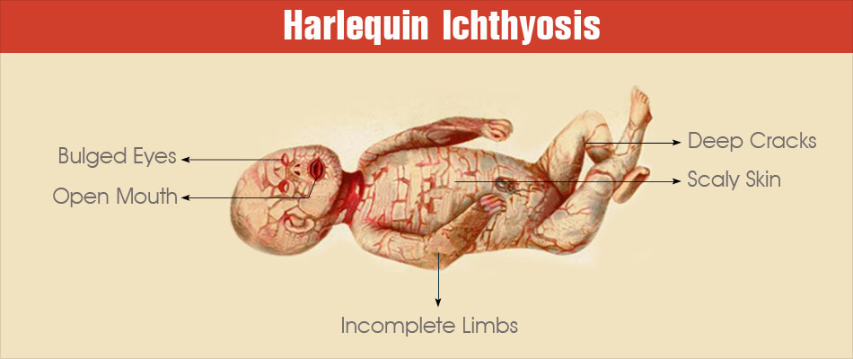 Harlequin Ichthyosis: The Disease That Leads to Birth of "Alien Babies" 91 Harlequin Ichthyosis - Cause, Symptoms, Diagnosis and Treatment