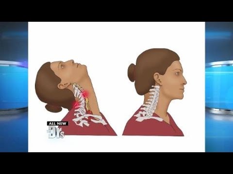 All You Need To Know About The Beauty Parlour Stroke Syndrome 92 Beauty Parlor Stroke Syndrome