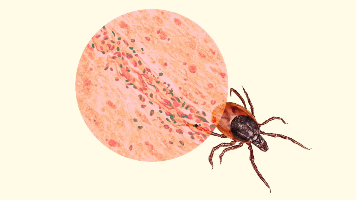 Experts Talk About The Powassan Virus : Causes, Symptoms, And Precautions 87 Lethal tick-borne disease Powassan virus is spreading in the US | Grist