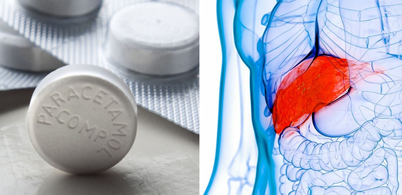 Paracetamol 650 causing Liver Damage