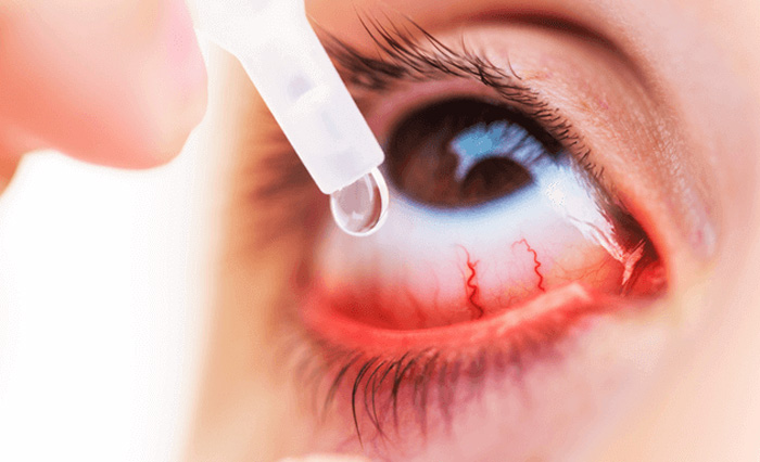 Conjunctivitis Cases Surge in India with Peak Infections Anticipated | Everything You Should Know 89 Nagaland Issues Advisory Over Eye Flu Outbreak In India